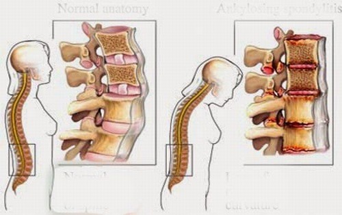 Các bệnh lý cột sống thường gặp