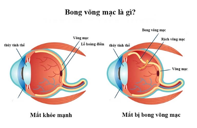 Các bệnh lý về dịch kính võng mạc có nguy hiểm không?