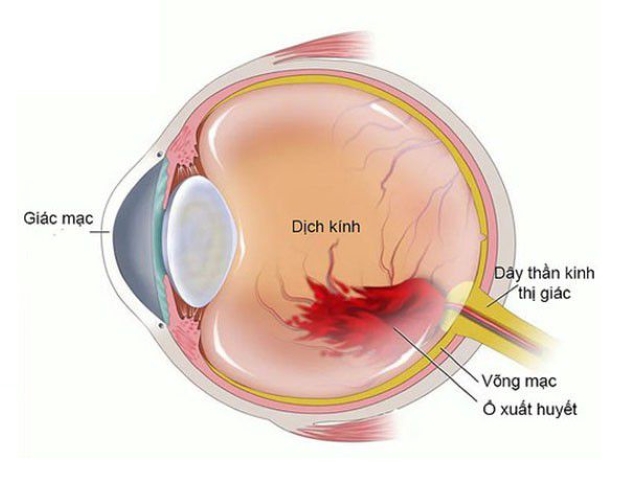 Các bệnh lý về dịch kính võng mạc có nguy hiểm không?