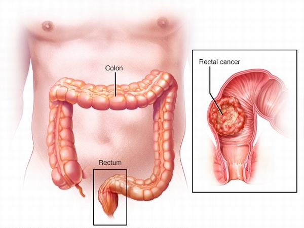 Các bệnh lý về trực tràng