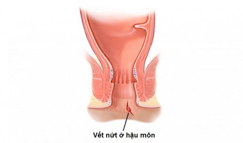 Các bệnh ở hậu môn nguy hiểm