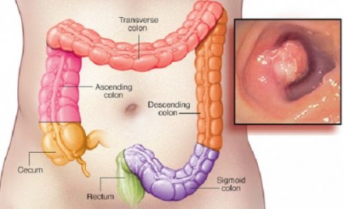 Các bệnh ở hậu môn nguy hiểm