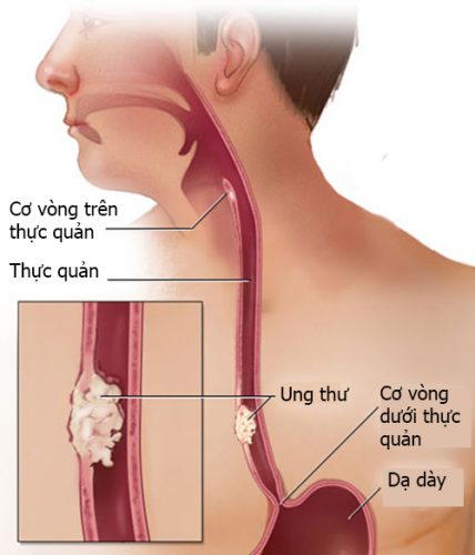 Các bệnh ở thực quản