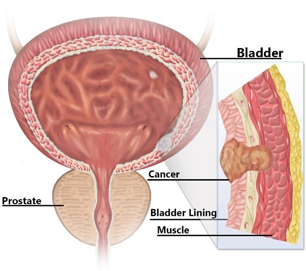 Các bệnh ung thư thường gặp ở nam giới và cách phòng chống