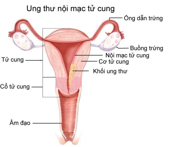 Các bệnh ung thư thường gặp ở nữ giới