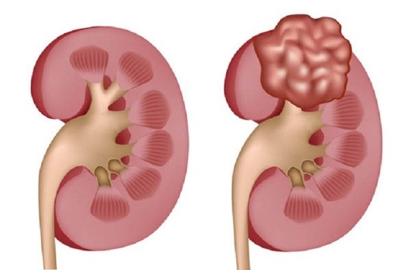 Các bệnh ung thư thường gặp ở trẻ em