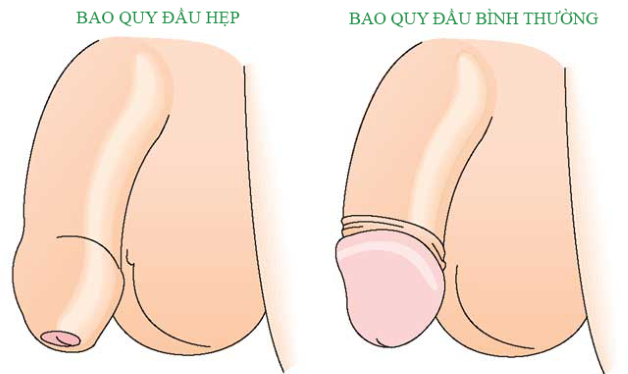 Các bệnh về bao quy đầu thường gặp nhất ở nam giới