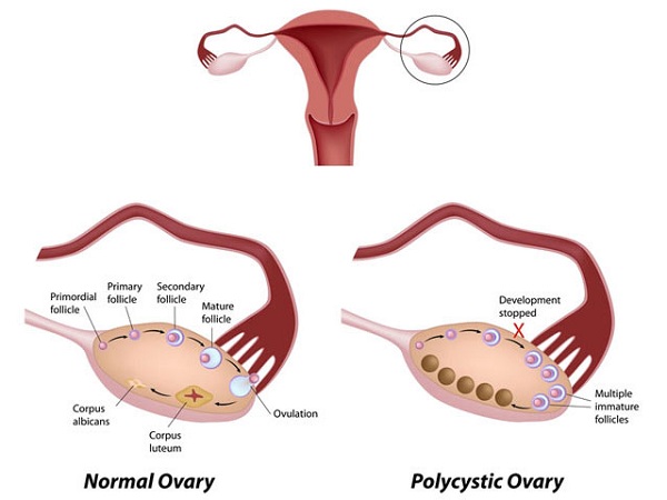 Các bệnh về buồng trứng