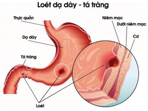 Các bệnh về đường tiêu hóa thường gặp