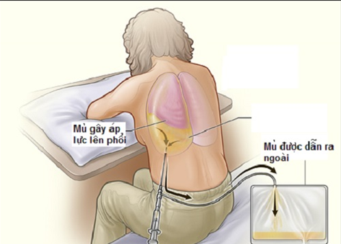 Các bệnh về phổi – phế quản thường gặp