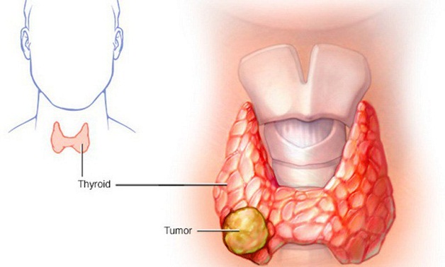 Các bệnh về tuyến giáp thường gặp