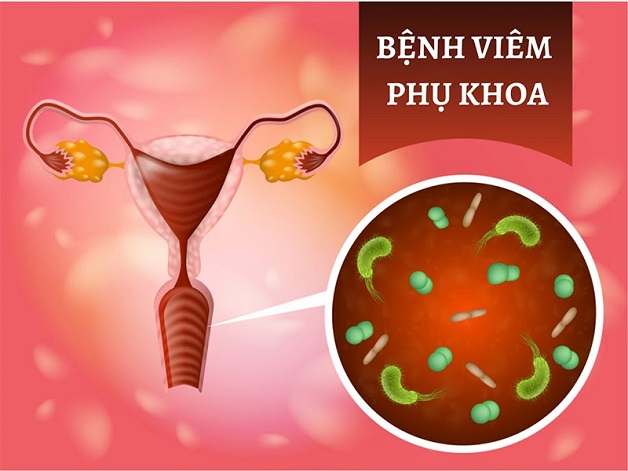 Các bệnh về viêm phụ khoa thường gặp ở nữ giới