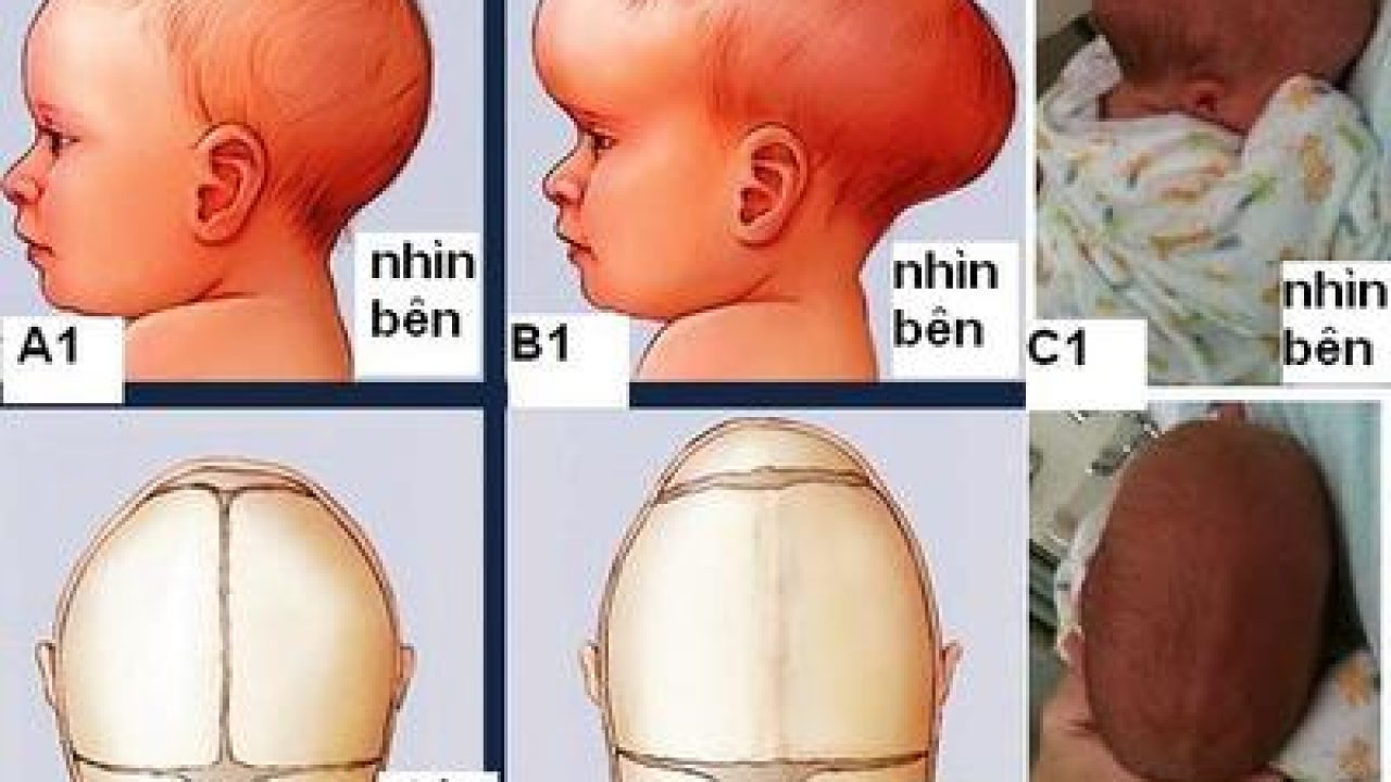 Các bệnh về xương ở trẻ em thấp khớp; hoại tử vô khuẩn