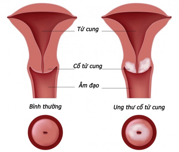 các bệnh viêm nhiễm, lộ tuyến, ung thư cổ tử cung