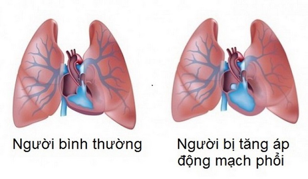 Các biến chứng của bệnh hẹp van 2 lá