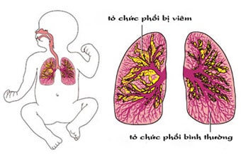 Các biểu hiện viêm phổi ở trẻ sơ sinh ba mẹ cần lưu ý