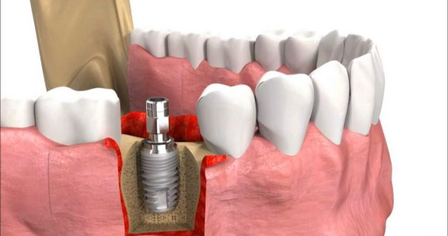 Các bước cấy ghép implant đúng chuẩn