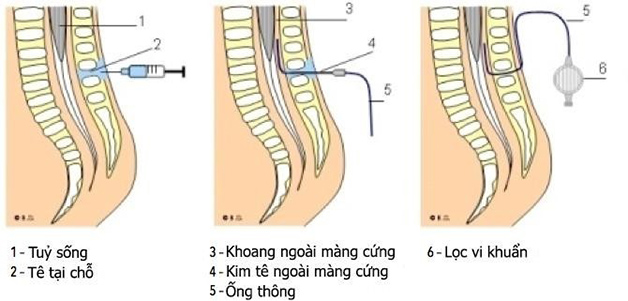 Các bước thực hiện gây tê ngoài màng cứng trong đẻ thường