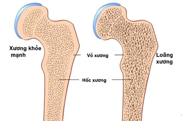 Các cách chữa loãng xương hiệu quả ở người cao tuổi