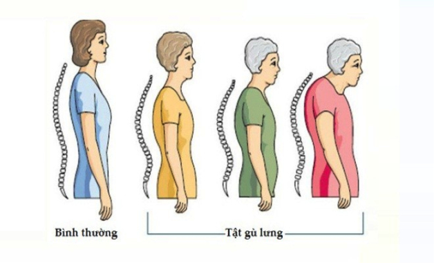 Các cách chữa loãng xương hiệu quả ở người cao tuổi