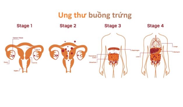 Các cách điều trị bệnh ung thư buồng trứng điển hình