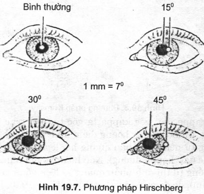 Các cách khám lác mắt phổ biến hiện nay