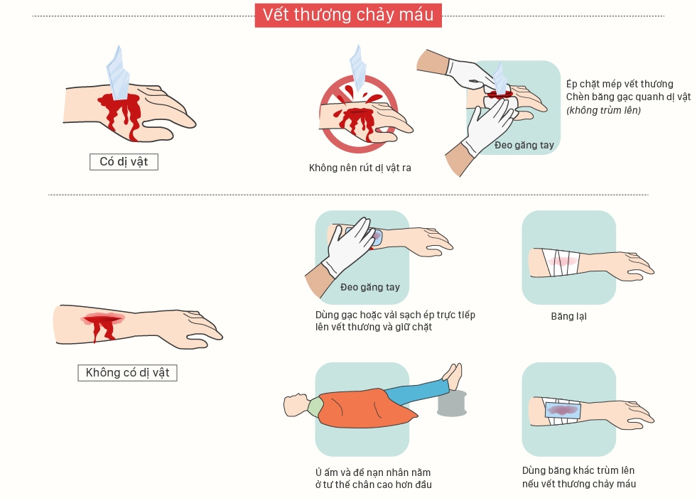 Các cách sơ cứu cầm máu nên biết để xử trí đúng cách