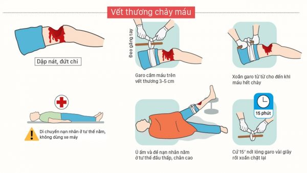 Các cách sơ cứu cầm máu nên biết để xử trí đúng cách