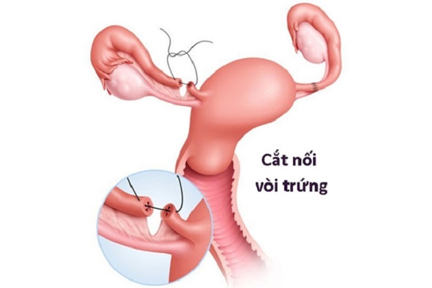 Các chị em phụ nữ đã biết thông vòi trứng như thế nào?