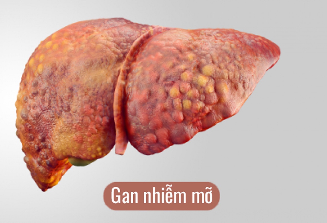 Các chỉ số gan nhiễm mỡ trong xét nghiệm máu