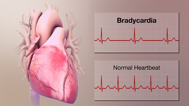 Các dạng rối loạn nhịp tim chậm và cách điều trị