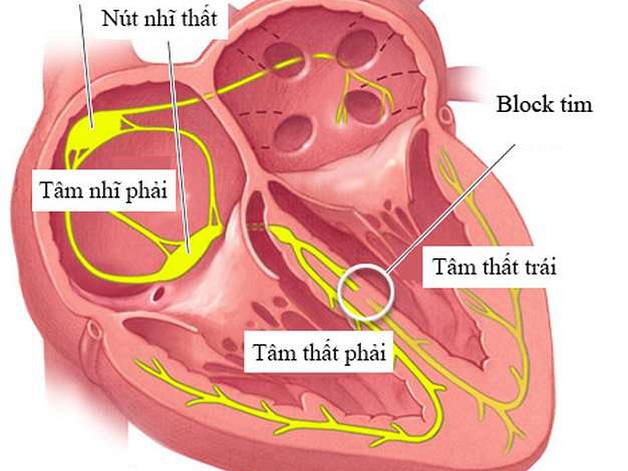 Các dạng rối loạn nhịp tim chậm và cách điều trị