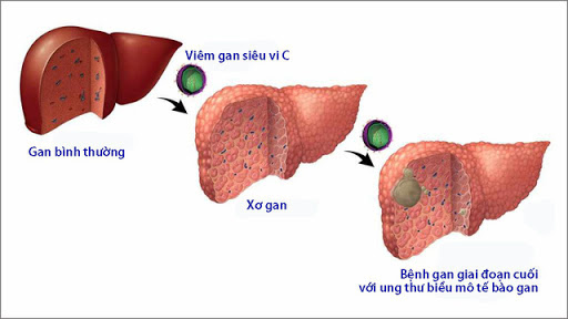 Các dạng viêm gan, nguyên nhân, cách nhận biết