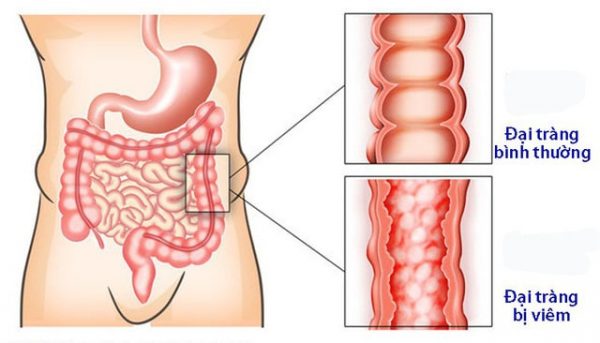 Các dấu hiệu cảnh báo bệnh viêm đại tràng co thắt