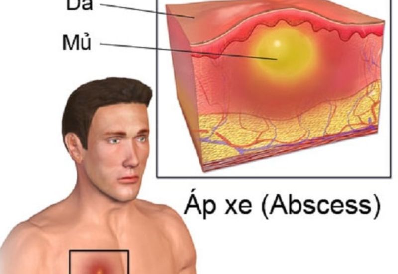 Các dấu hiệu cảnh báo cần mổ áp xe ngay kẻo biến chứng