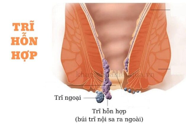 Các dấu hiệu của bệnh trĩ: Làm sao để nhận biết và điều trị