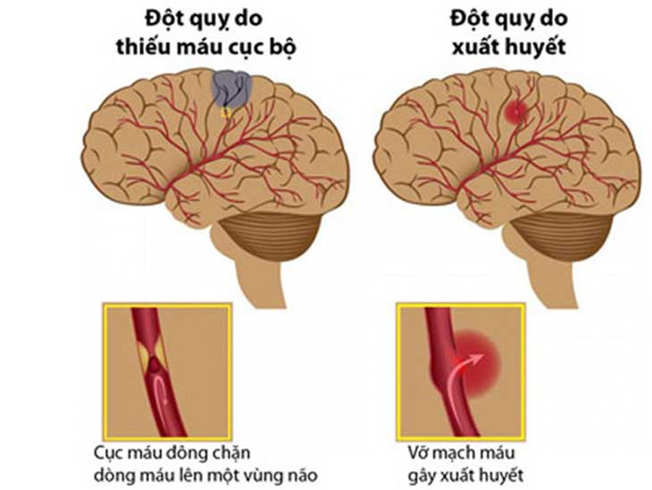 Các di chứng đột quỵ phổ biến và cách phòng ngừa