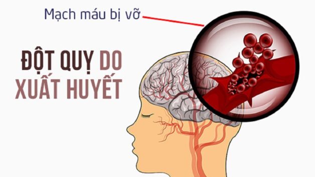 Các di chứng đột quỵ phổ biến và cách phòng ngừa