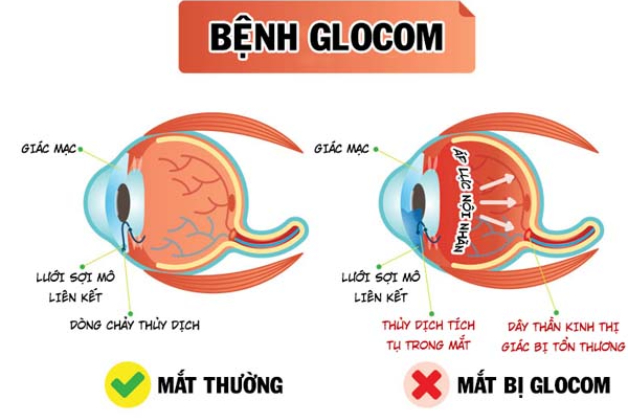 Các giai đoạn bệnh glôcôm và triệu chứng tại mỗi giai đoạn