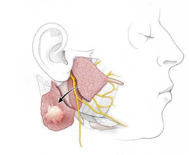 Các giai đoạn của bệnh ung thư tuyến nước bọt