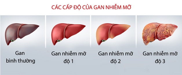 Các giai đoạn của gan nhiễm mỡ và cách nhận diện