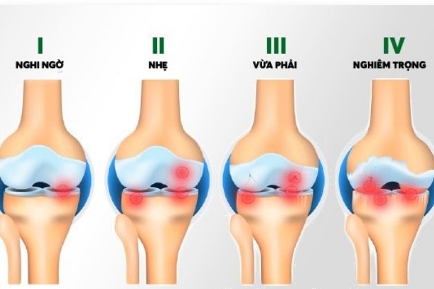 Các giai đoạn của thoái hóa khớp gối m17 và lưu ý điều trị