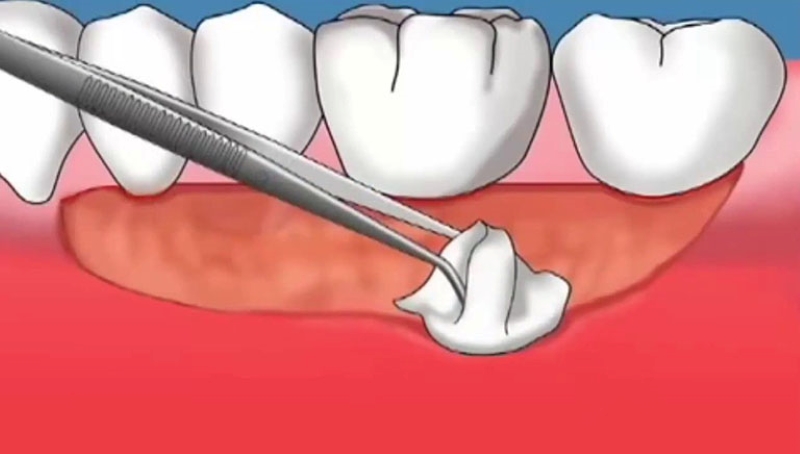 Các giai đoạn của tình trạng tụt lợi răng lung lay