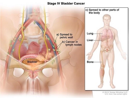Các giai đoạn của ung thư bàng quang