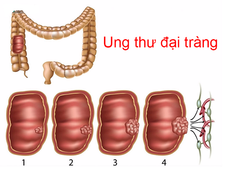 Các giai đoạn của ung thư đại tràng