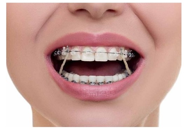 Các giai đoạn niềng răng và điều cần lưu ý