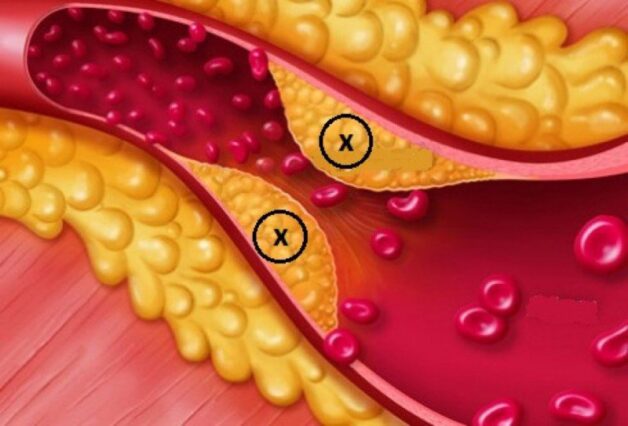 Các giai đoạn phục hồi chức năng sau đột quỵ não