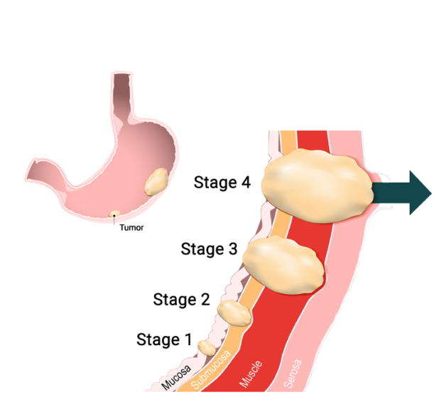 Các giai đoạn tiến triển của bệnh ung thư dạ dày