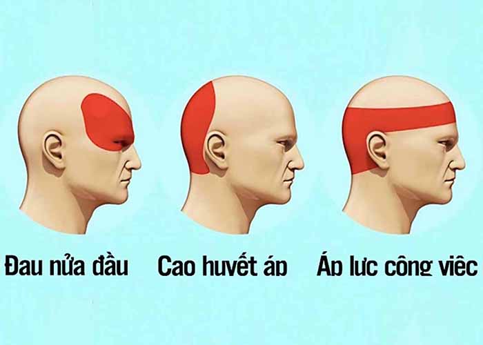 Các loại bệnh đau đầu và tác hại nếu không điều trị kịp thời