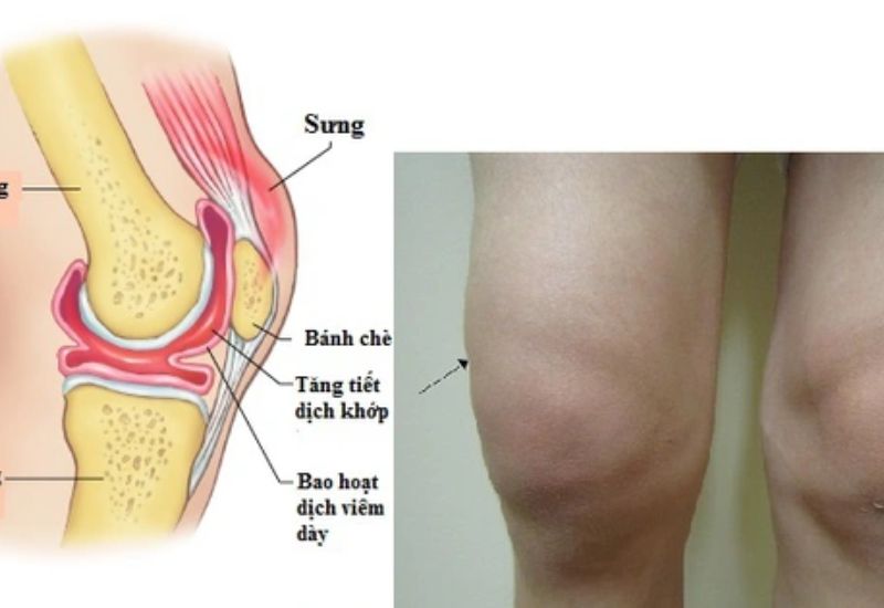 Các loại chấn thương phần mềm và cách xử trí